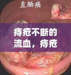痔疮不断的流血,痔疮不断流血不止